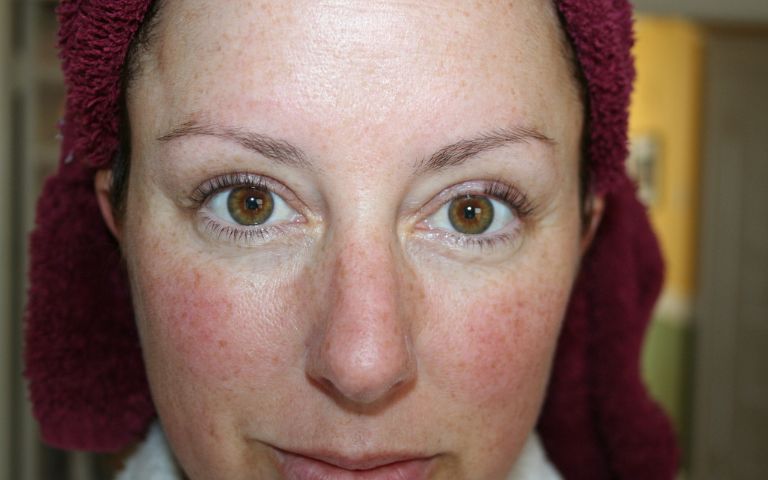 Rosacea - What You Need To Know About