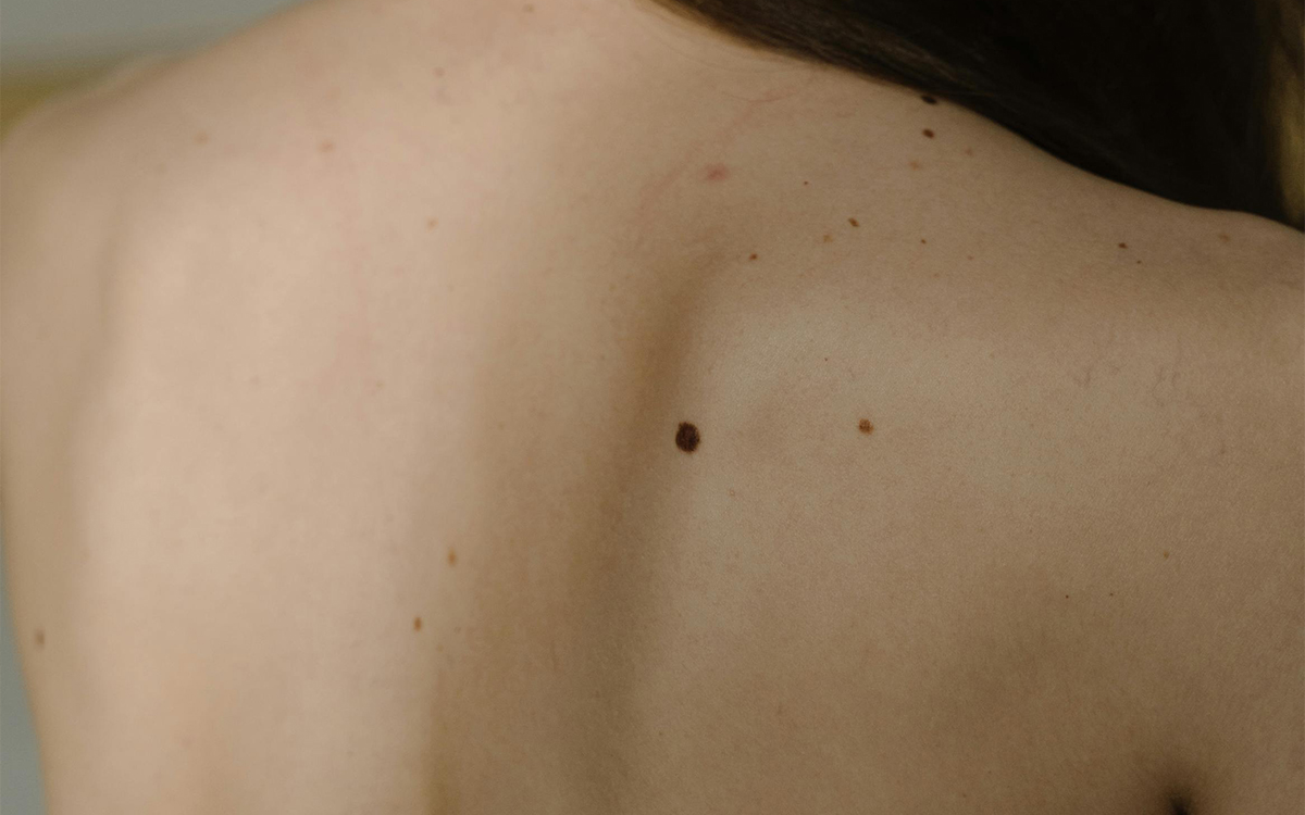skin cancer mole