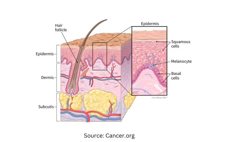 Skin cancer moles